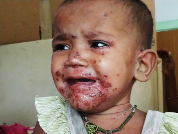 Skin infection — very common in the villages